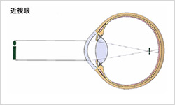 近視眼