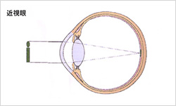 近視眼