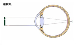 遠視眼