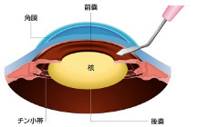 白内障手術方法1