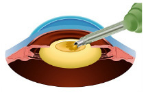 白内障手術方法2