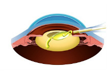 白内障手術方法3